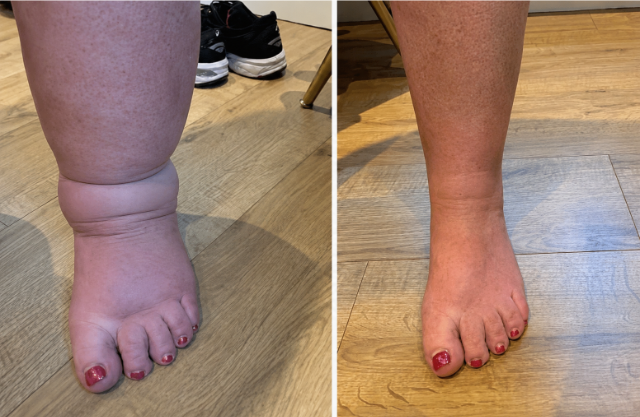 Swollen feet before and after comparison